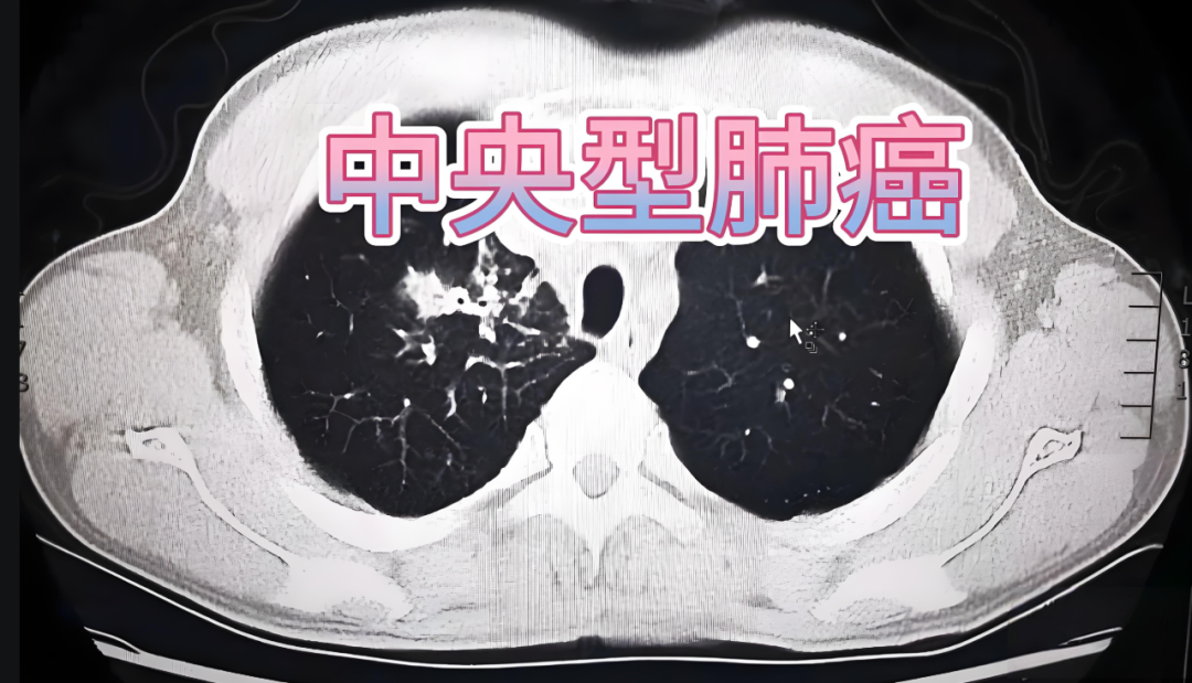 上海太安医院中医科：如何根据体检报告简单判断肺癌是否严重？上海肺癌中医哪个医院最好