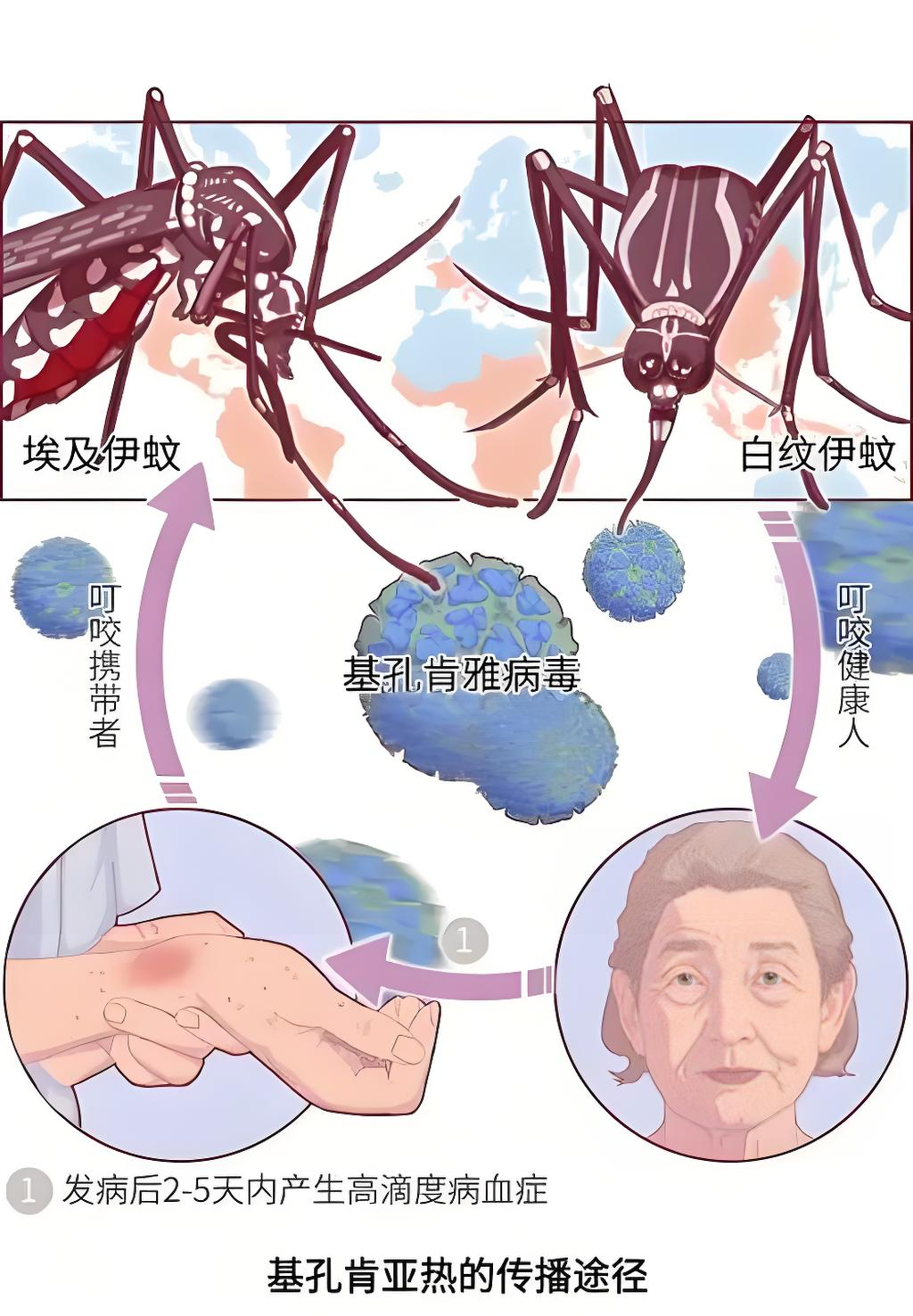 基孔肯雅热的“秘密档案”，皮肤科医生为你揭秘