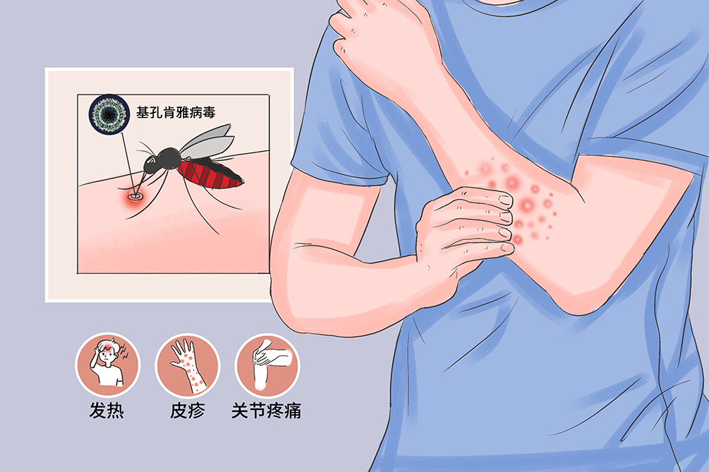 基孔肯雅热的“秘密档案”，皮肤科医生为你揭秘
