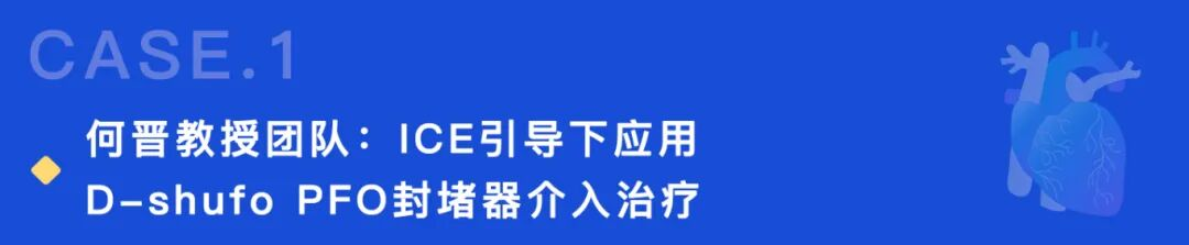 D-shufo新一代PFO封堵器亮相2024中国结构周 D-shufo新一代PFO封堵器亮相2024中国结构周