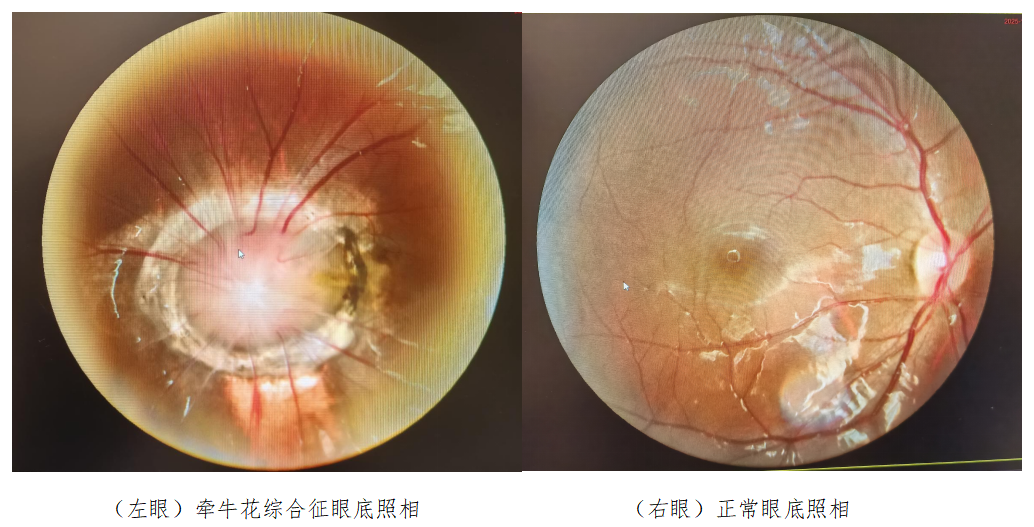 永春爱尔眼科接诊7岁患儿：厚重镜片后，竟是“牵牛花”在作怪