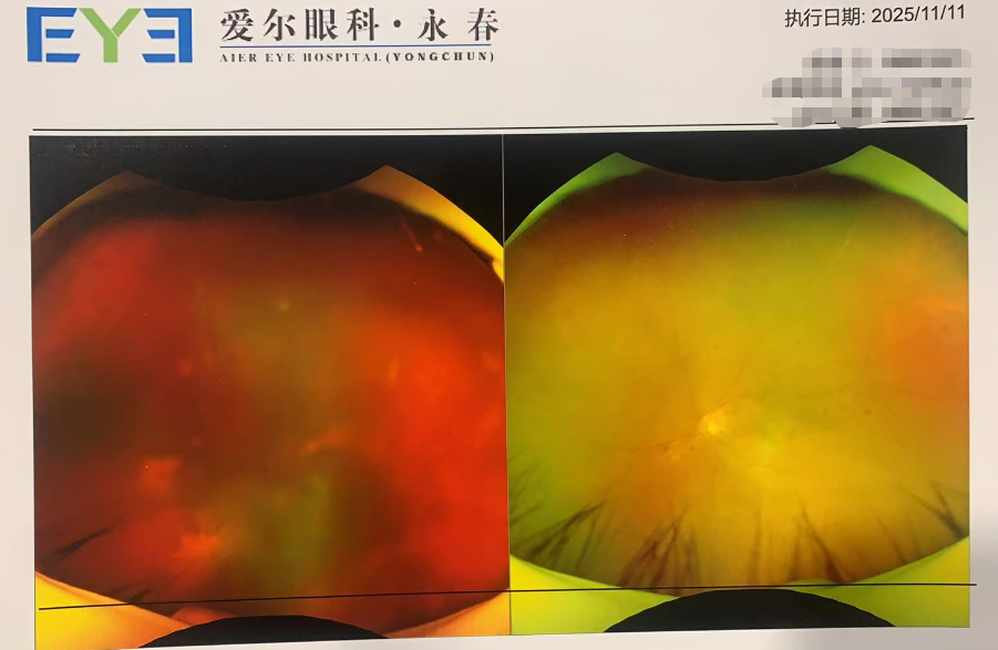 七旬阿姨视力骤降，幕后“元凶”竟是它！永春爱尔眼科提醒：控糖莫忘查眼底