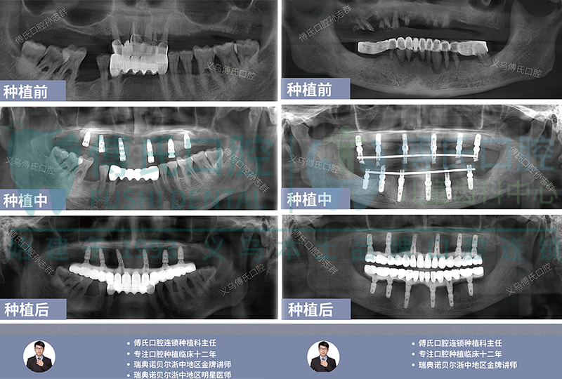 孙志群种植主任案例