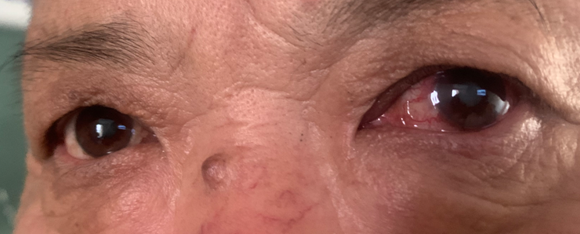 从“眼睛红”到“近乎失明”只隔了半年！永春爱尔眼科提醒：这个“隐形视力杀手”要当心！