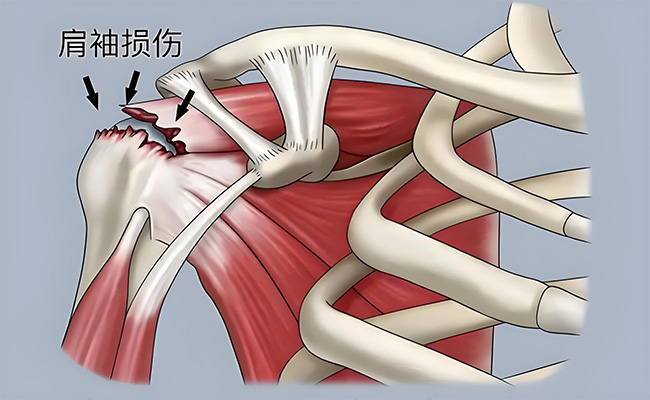 肩痛别乱动！广州仁爱缓解65岁大伯“举手难”，这个治疗让他连连称赞
