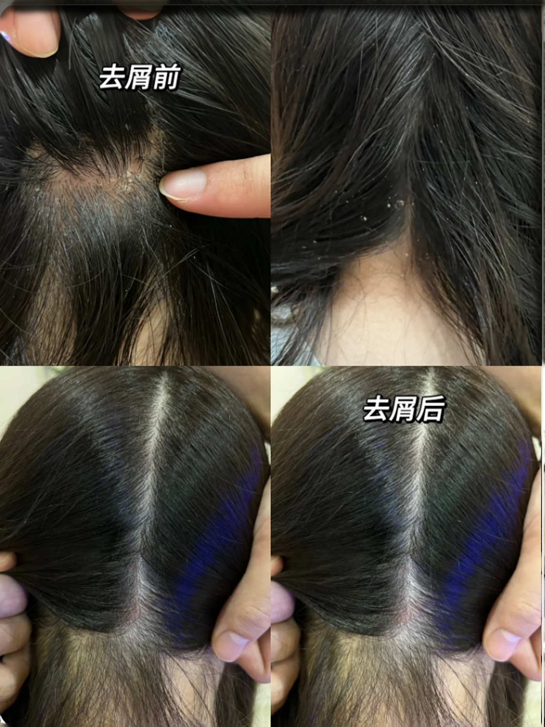 十芳清洗发水去屑前后对比图:去屑前头屑明显,头皮不干净;去屑后有效去屑,头皮清爽干净无屑,头发蓬松有光泽,告别头屑困扰,展现健康头皮状态。