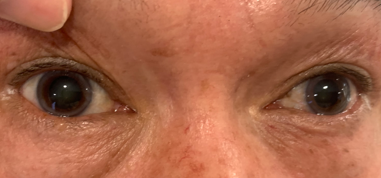 “乱用药” 福建61岁老人误用阿托品缓解眼干，加重白内障病情，永春爱尔眼科呼吁科学护眼