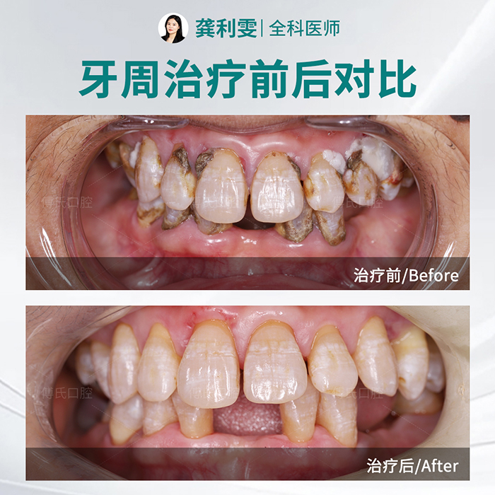 义乌傅氏口腔牙周案例 义乌傅氏口腔牙周案例