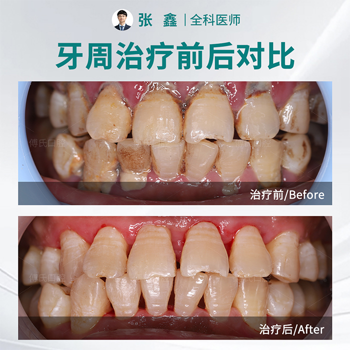 义乌傅氏口腔牙周案例 义乌傅氏口腔牙周案例