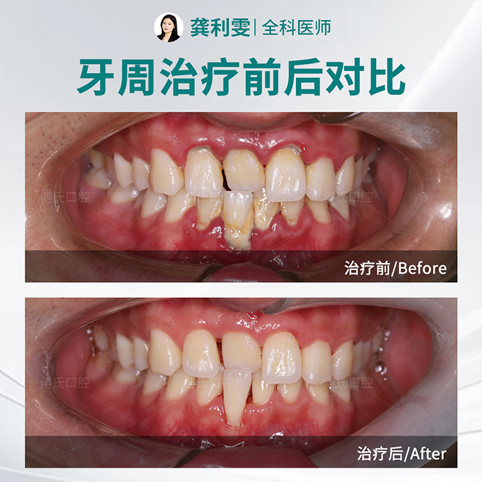 义乌傅氏口腔牙周案例 义乌傅氏口腔牙周案例
