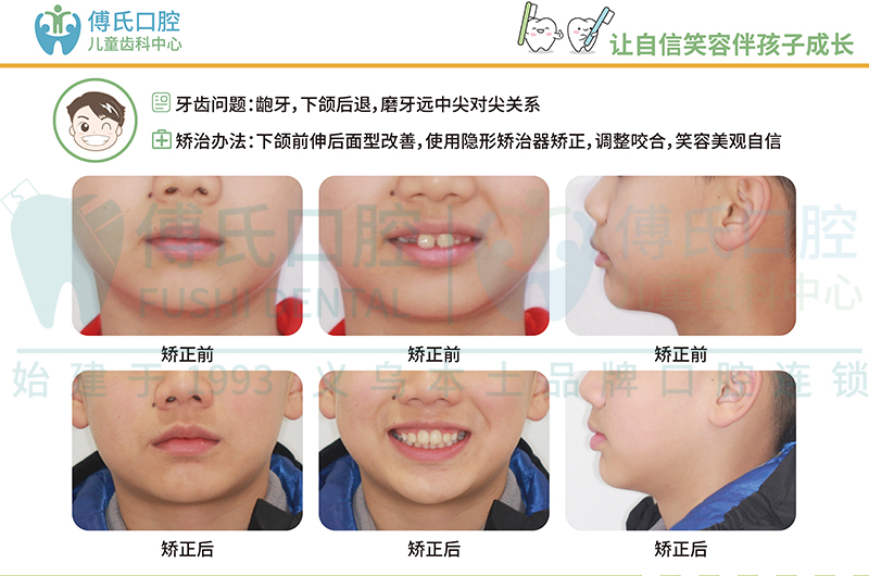 义乌傅氏口腔儿童早期矫正案例
